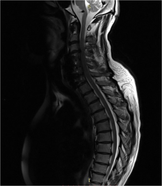 Post-surgery sagittal MRI.