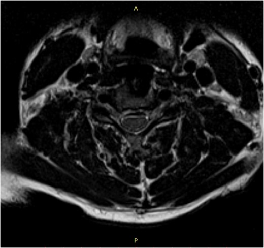 Post-surgery axial MRI.