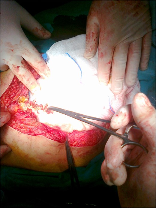 Excision of an elongated bone-like lesion located in the lower abdomen, attached on the peritoneum.