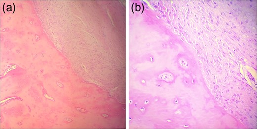 (a, b) Maturation pattern with fibroblastic stroma in association with mature, compact bone and presence of osteoblastic rimming and immature woven bone at the interface between them.