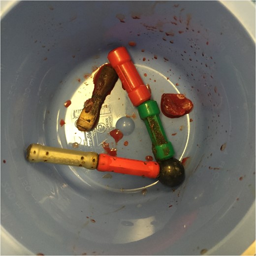 Ingested magnetic foreign bodies that were retrieved intraoperatively.