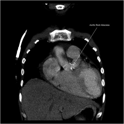 CT scan image of aortic root abscess.