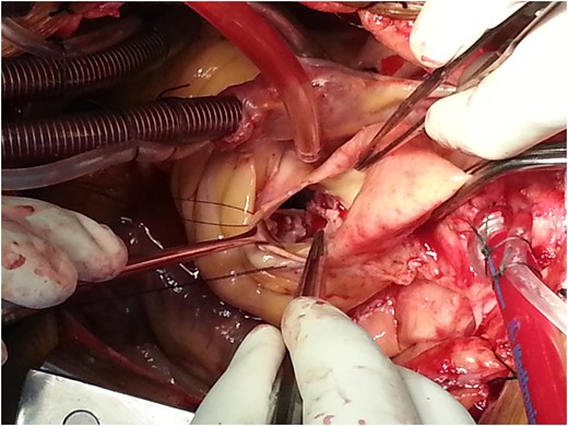 Intraoperative image of aortic annular abscess.