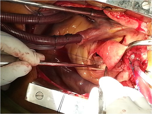Aortic root reconstruction with pericardium.