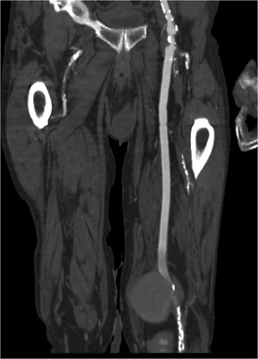 Coronal view of popliteal PS of distal anastomosis site of femoral–popliteal bypass.