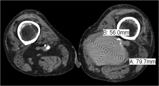 Axial view of popliteal PS measuring 7.97 × 5.6 cm.