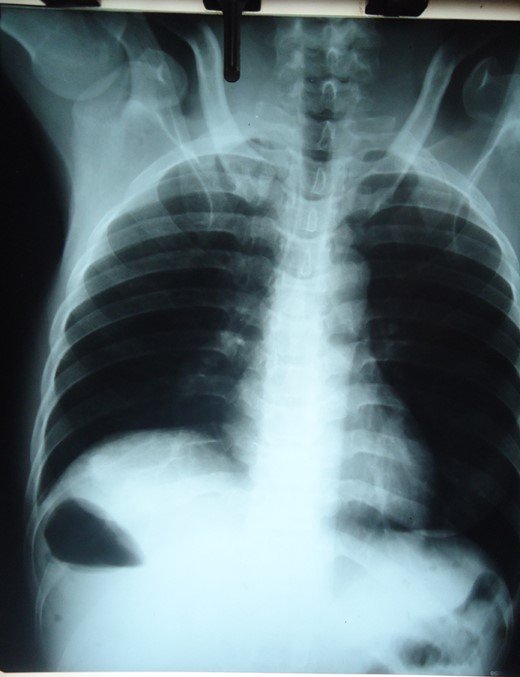 Chest X-ray showing right sub-diaphragmatic shadow with air fluid levels from trapped bowel.