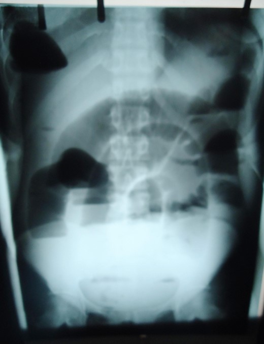 Plain abdominal X-ray showing distended small bowel loops and right sub-diaphragmatic shadow with air fluid levels from trapped bowel.