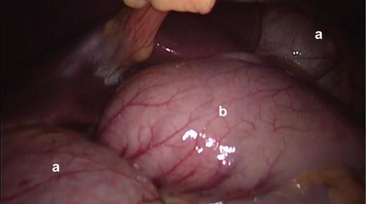 Initial picture in diagnostic laparoscopy. It is seen that the herniated colon (a), through the foramen of Winslow and the stomach (b).