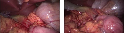 Hepatoduodenal ligament, with visualization of the herniated colon (a) and mesocolon in torsion.