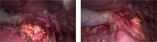 Foramen of Winslow after reduction of hernia.