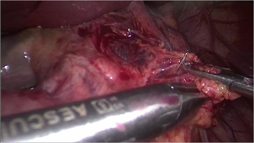 Defect closure with metal clips.