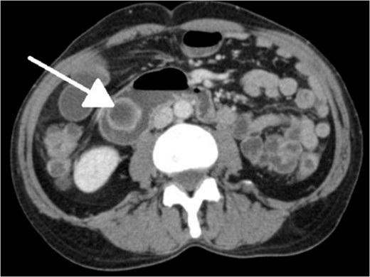 CT imaging showing ‘wind-sock’ sign (transverse cut).