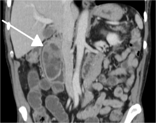 CT imaging showing ‘wind-sock’ sign (coronal cut).