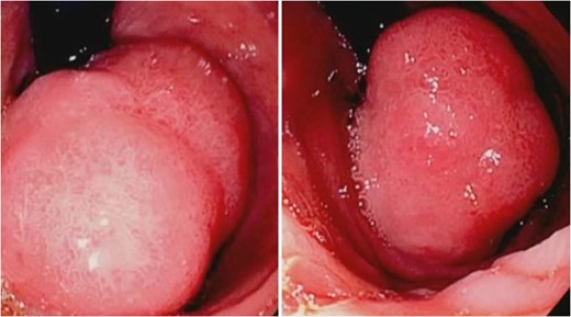 Retroflexed endoscopic view of hamartoma.