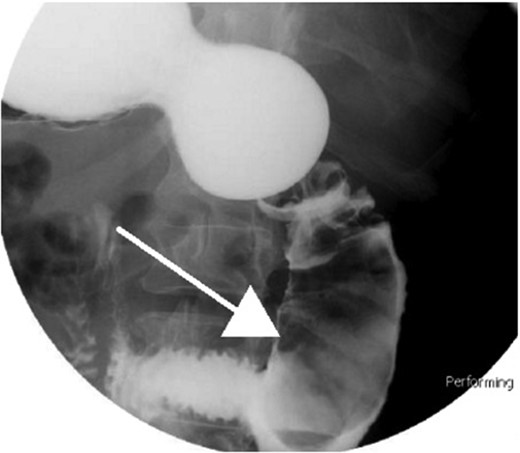 Small bowel series showing duodenal filling defect (posterior view).