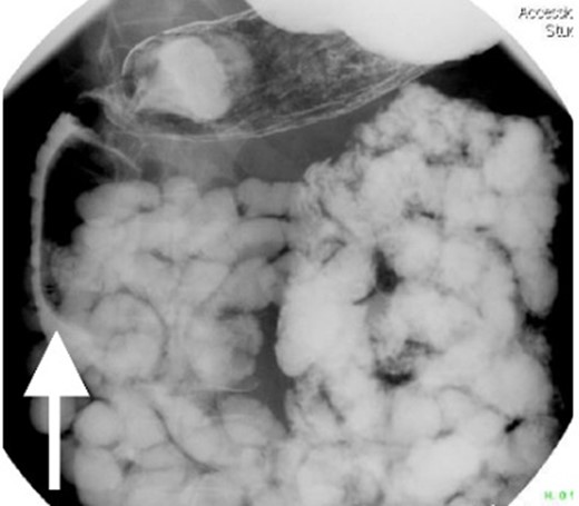 Small bowel series showing duodenal filling defect (anterior view).