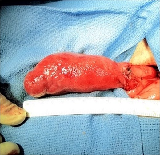 Resected hamartoma gross specimen.