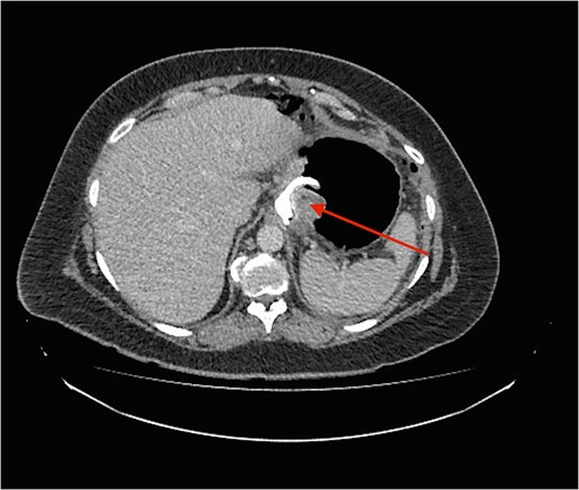Cross section CT image demonstration the site of the band with no collection (red arrow).