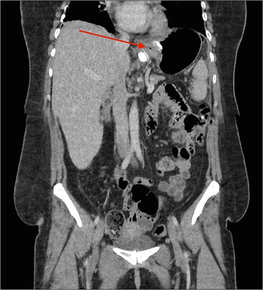 CT image demonstrating the air loculation site next to the band (red arrow).