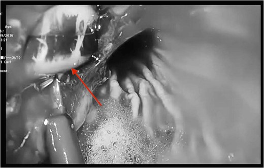 Transgastric image of the gastric band and its retrieval.