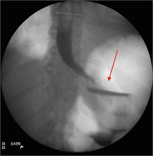 A postoperative Gastrografin swallow showing no leaks 3 days following the procedure.