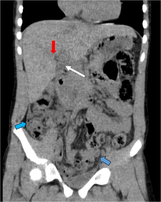 An abdominal CT showed a collapsed gallbladder with wall thickening or pericholecystic fluid (white arrow), a grade II hepatic laceration of Segment 5 (red arrow) and an increased amount of free fluid in the abdomen (blue arrows).
