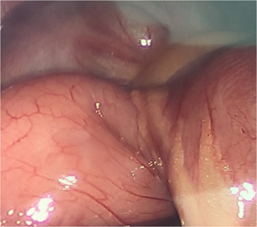Laparoscopic view of anomalous vessel with relative constriction of the bowel.