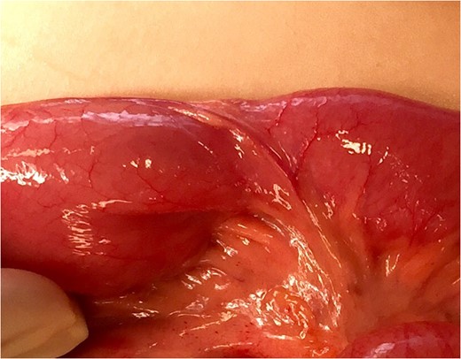 Anomalous mesenteric vessel partially encircling the bowel.
