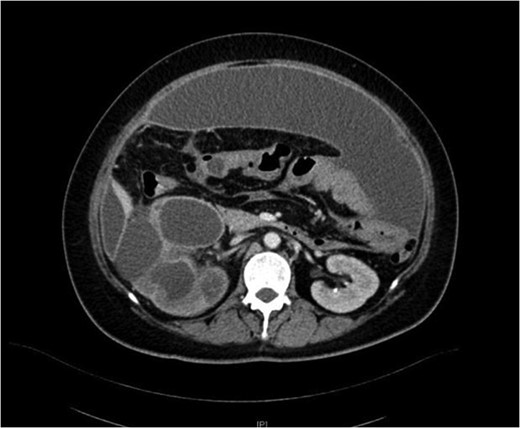 Anterior preperitoneal collection.