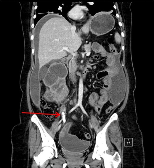 Proximal ureteric calculus (red arrow).