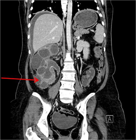 Right hydronephrosis with lower pole mass (red arrow).