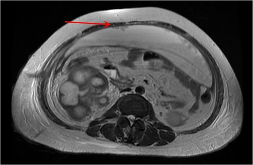 MRI showing non-dependent peritoneal nodules (red arrow).