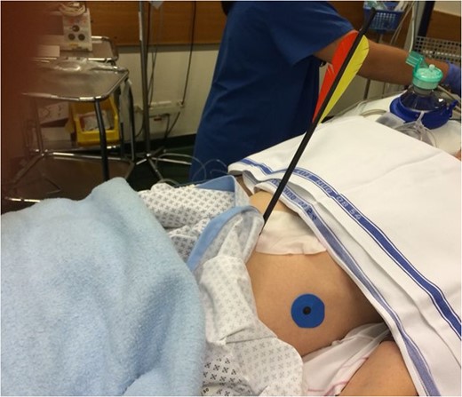 Image of the patient immediately after admission, showing the entry point of the arrow in the abdomen.