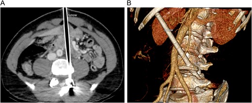 Intravenous contrast-enhanced CT of the abdomen. (A) Axial CT image shows the arrow, tracking through the liver (1), the pancreas (2) and the duodenum, between the aorta (3) and the superior mesenteric vessels (4). (B) 3D volume rendering CT reformation shows the oblique trajectory of the arrow, between the aorta (1) and the superior mesenteric artery (2). The arrow passes through the lateral aspect of the fourth vertebral lumbar body (L4) and ends into the left pedicle of the fifth lumbar vertebra (L5).