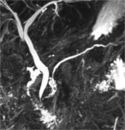 Magnetic resonance pancreatography (1 month after trauma): leak of pancreatic fluid (1), arising from the cephalic part of the main pancreatic duct (2), consistent with a ductal laceration.