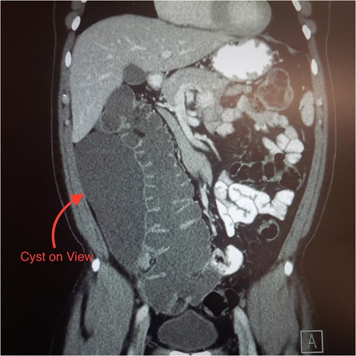 CT abdomen showing the cystic mass (coronal view).