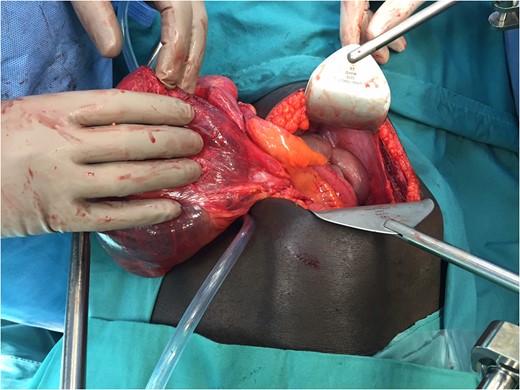 Cyst in view connected to ascending colon.