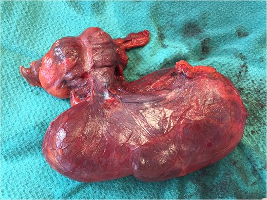 Right hemicolectomy performed.