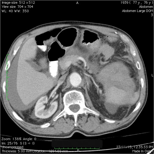 CT scan of the abdomen and pelvis: splenic injury with a large amount of blood in the left upper quadrant, perihepatic region and pelvic areas.