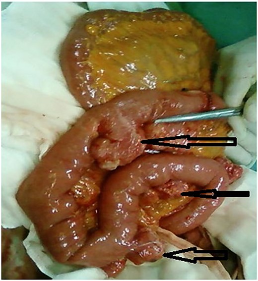 Intraoperative findings: multiple diverticula (arrows) arising at the mesenteric border of the jejunum.