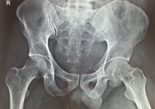 Antero-posterior radiograph showing subcapital fracture line of left femur neck.