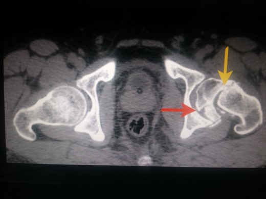 CT scan image of the patient in transverse cut. Yellow arrow pointing to the subcapital fracture line of left hip and red arrow pointing to the oblique fracture line of left femur head.