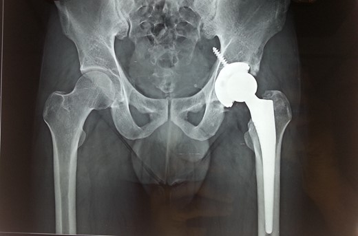 Recent 5 years follow-up antero-posterior radiograph image of the patient with uncemented total hip arthroplasty prosthesis in situ.