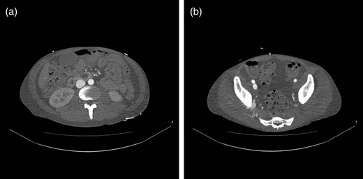 (a) CT scan demonstrating rapid contrast filling of the vena cava. (b) CT scan demonstrating contrast filling of the right common iliac vein.