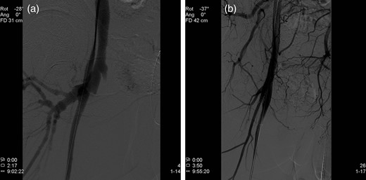 (a) Angiography demonstrating an AV fistula between the right superficial femoral artery and the femoral vein. (b) A stent-graft is implanted in the cranial part of the right superficial femoral artery, sealing the AV fistula.