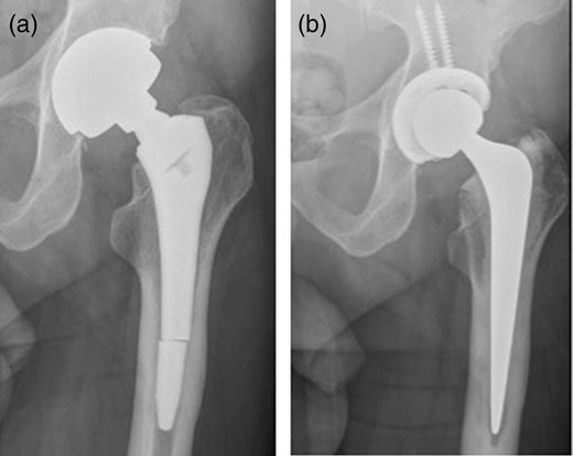 (a) Distal stem fracture of left hip prosthesis. (b) Post-revision X-ray.