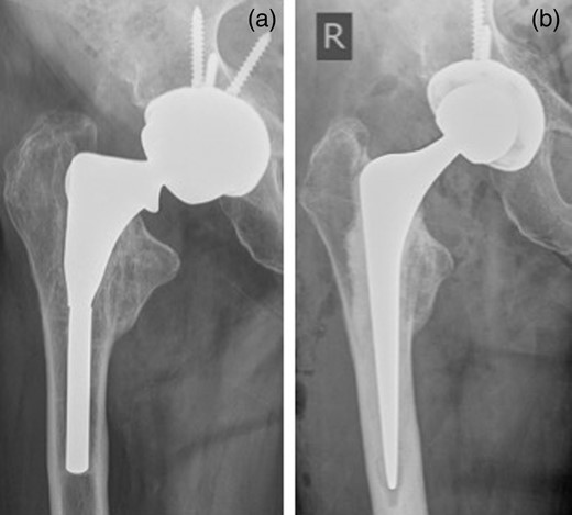 (a) Fracture through the stem of right femoral component. (b) Post-revision X-ray.