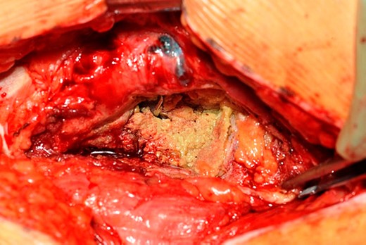 Metalosis in Case 1.