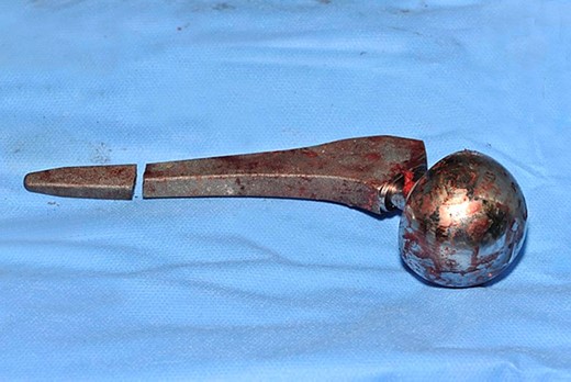 Broken stem in Case 1.